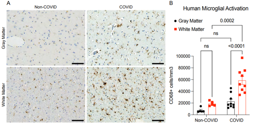 SARS-CoV-2感染后人白質(zhì)小膠質(zhì)細(xì)胞的反應(yīng)性（圖源：bioRxiv）