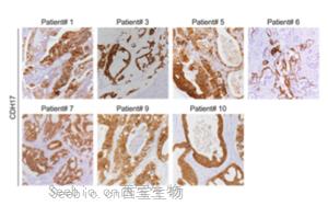 靶向鈣黏蛋白17(Cadherin-17/CDH17)的CAR-T細(xì)胞系統(tǒng)性遞送策略：安全有效治療<font color='red'>結(jié)直腸癌肝轉(zhuǎn)移</font>的新突破